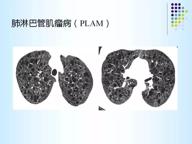 【PPT】肺多发囊状病变的CT诊断
