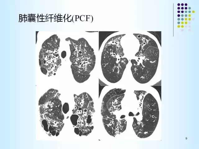 【PPT】肺多发囊状病变的CT诊断