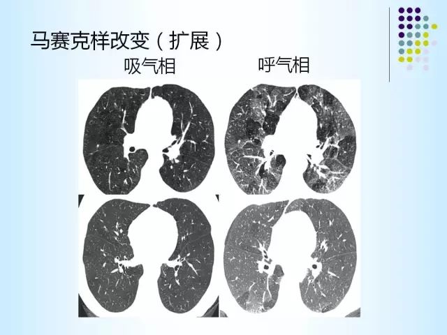 【PPT】肺多发囊状病变的CT诊断