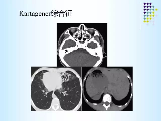 【PPT】肺多发囊状病变的CT诊断