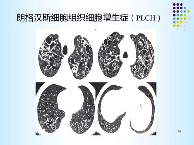 【PPT】肺多发囊状病变的CT诊断