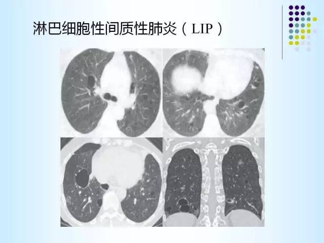 【PPT】肺多发囊状病变的CT诊断