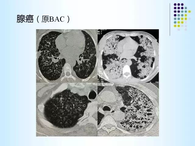 【PPT】肺多发囊状病变的CT诊断