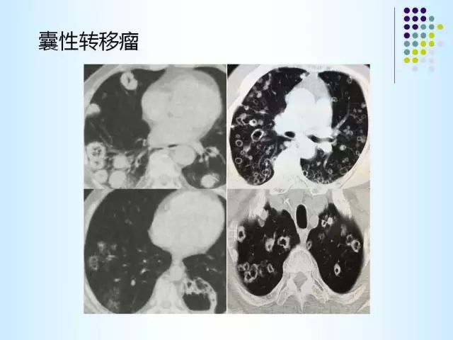 【PPT】肺多发囊状病变的CT诊断