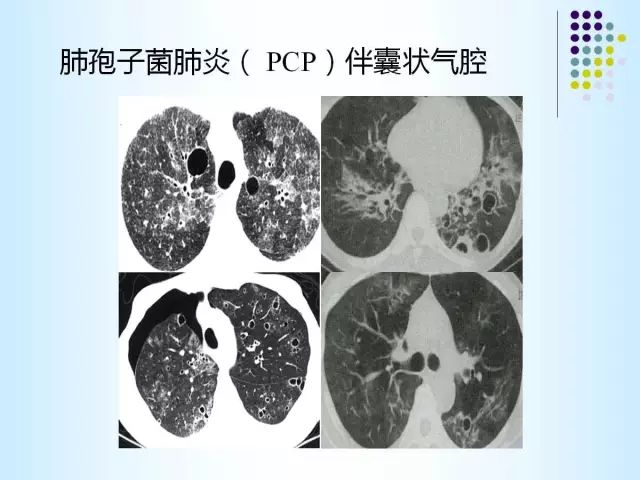 【PPT】肺多发囊状病变的CT诊断