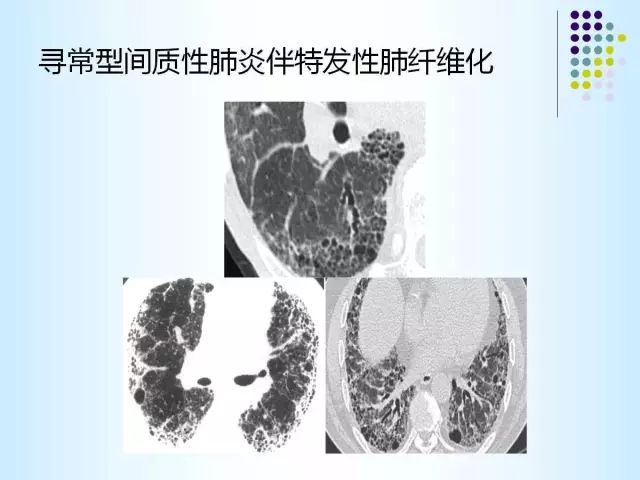【PPT】肺多发囊状病变的CT诊断