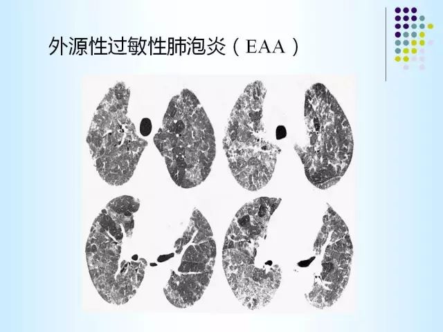 【PPT】肺多发囊状病变的CT诊断