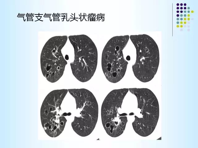 【PPT】肺多发囊状病变的CT诊断