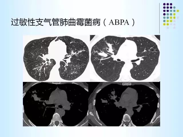 【PPT】肺多发囊状病变的CT诊断