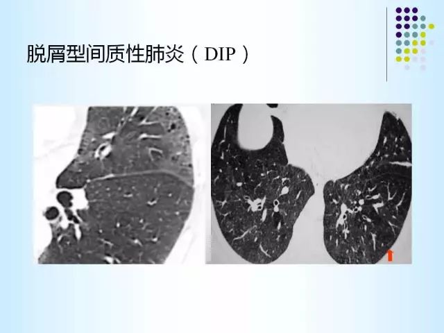 【PPT】肺多发囊状病变的CT诊断