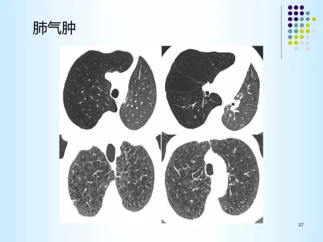 【PPT】肺多发囊状病变的CT诊断
