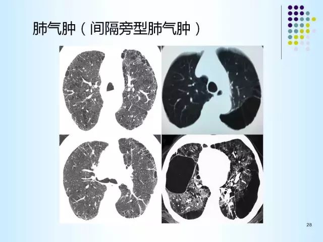 【PPT】肺多发囊状病变的CT诊断