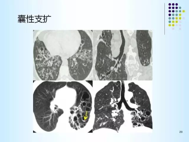 【PPT】肺多发囊状病变的CT诊断