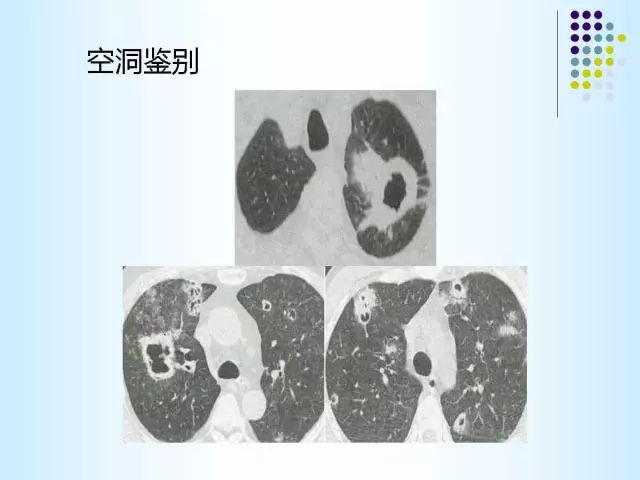 【PPT】肺多发囊状病变的CT诊断
