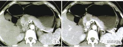 【病例】胰腺微囊型浆液性囊腺瘤1例CT