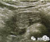 【病例】胰腺微囊型浆液性囊腺瘤1例CT 【病例】胰腺微囊型浆液性囊腺瘤1例CT