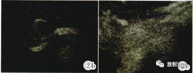 【病例】胰腺微囊型浆液性囊腺瘤1例CT 【病例】胰腺微囊型浆液性囊腺瘤1例CT