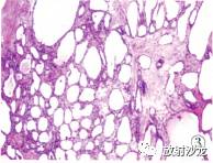 【病例】胰腺微囊型浆液性囊腺瘤1例CT 【病例】胰腺微囊型浆液性囊腺瘤1例CT
