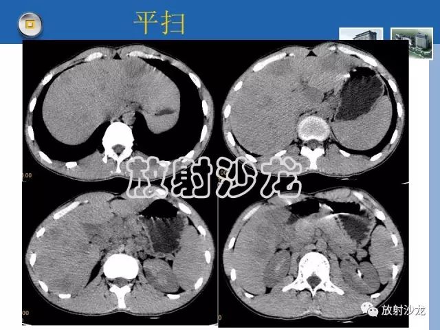 【病例】肝结核1例CT影像诊断