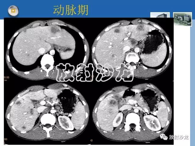 【病例】肝结核1例CT影像诊断