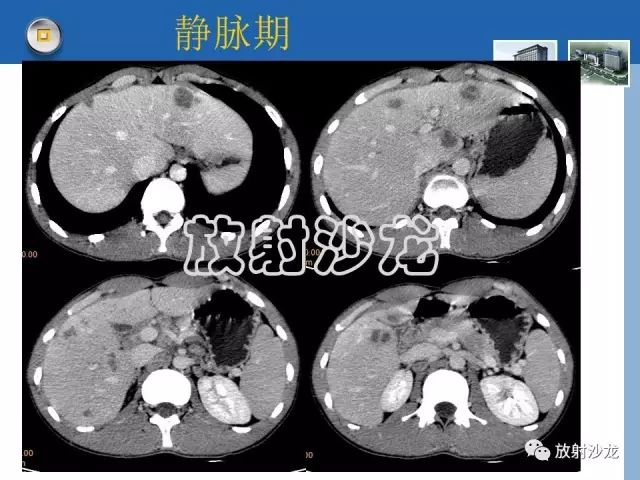【病例】肝结核1例CT影像诊断