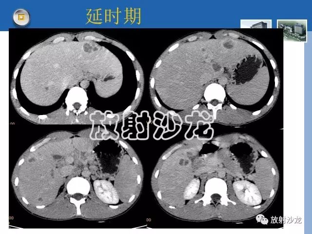 【病例】肝结核1例CT影像诊断