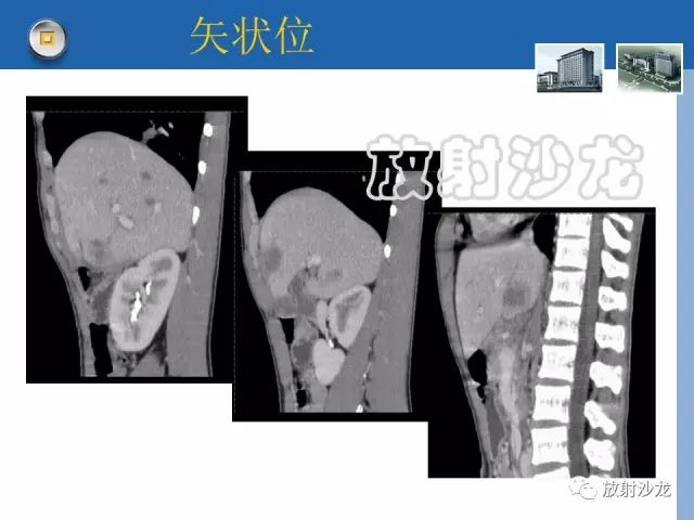 【病例】肝结核1例CT影像诊断