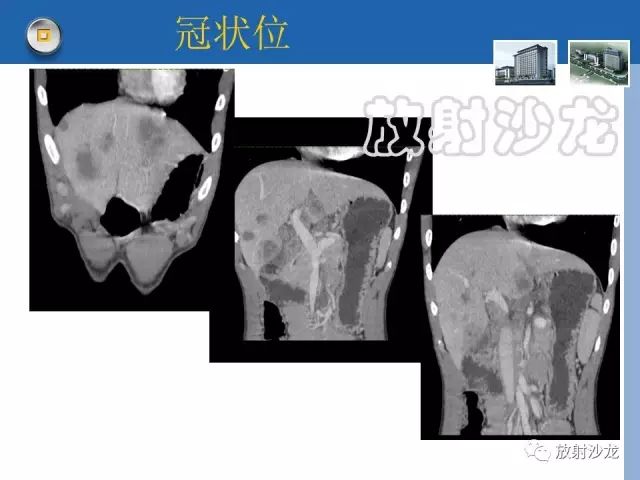 【病例】肝结核1例CT影像诊断