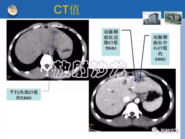 【病例】肝结核1例CT影像诊断