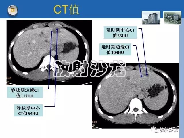 【病例】肝结核1例CT影像诊断