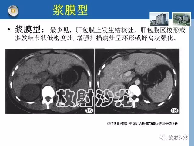 【病例】肝结核1例CT影像诊断