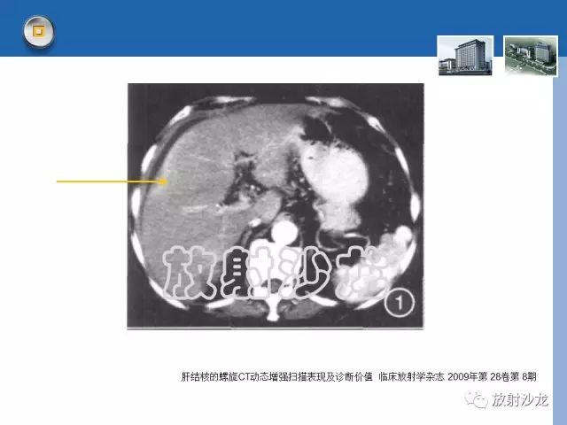 【病例】肝结核1例CT影像诊断