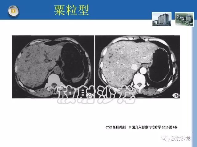 【病例】肝结核1例CT影像诊断