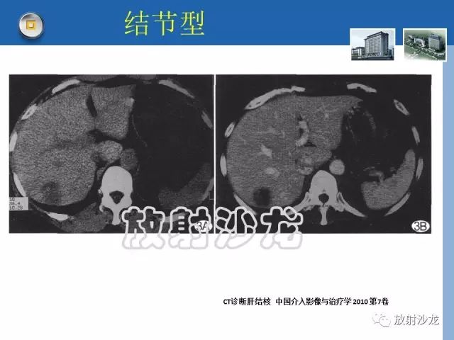 【病例】肝结核1例CT影像诊断