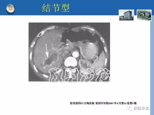 【病例】肝结核1例CT影像诊断