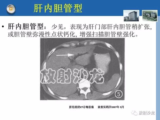 【病例】肝结核1例CT影像诊断