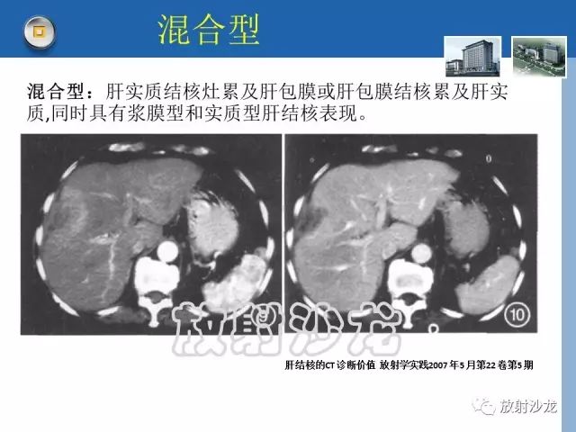 【病例】肝结核1例CT影像诊断