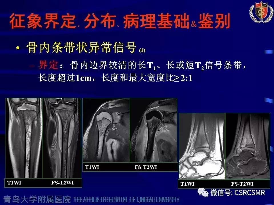 【PPT】长骨骨髓炎与骨肉瘤—MR征象对比观察
