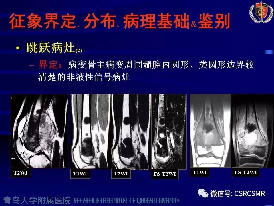 【PPT】长骨骨髓炎与骨肉瘤—MR征象对比观察