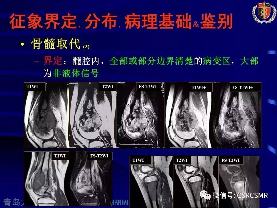 【PPT】长骨骨髓炎与骨肉瘤—MR征象对比观察