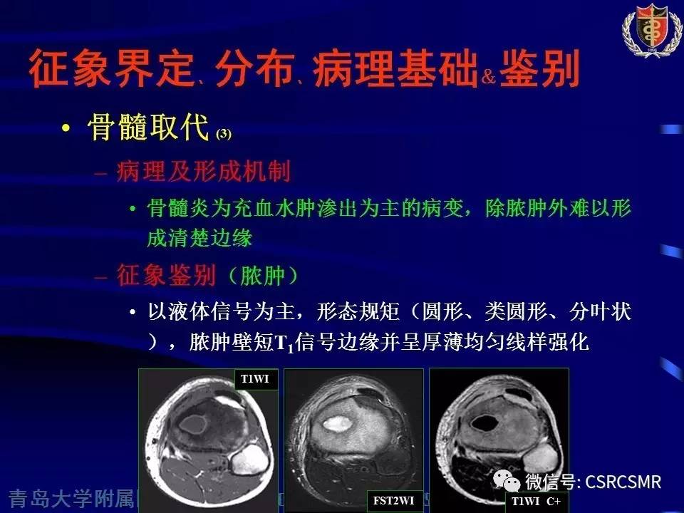 【PPT】长骨骨髓炎与骨肉瘤—MR征象对比观察