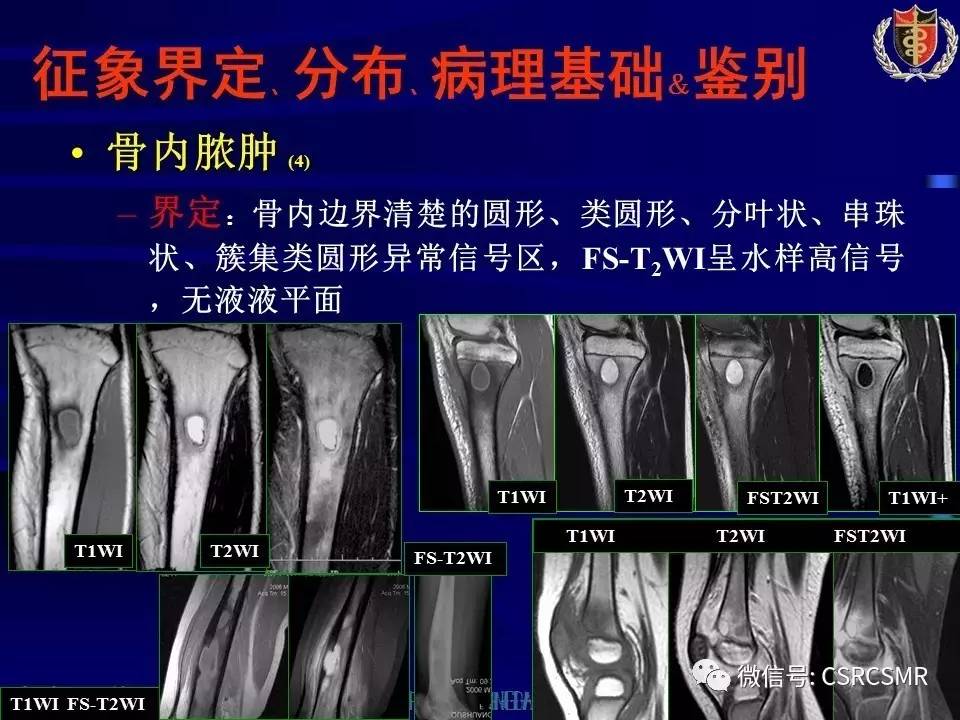 【PPT】长骨骨髓炎与骨肉瘤—MR征象对比观察