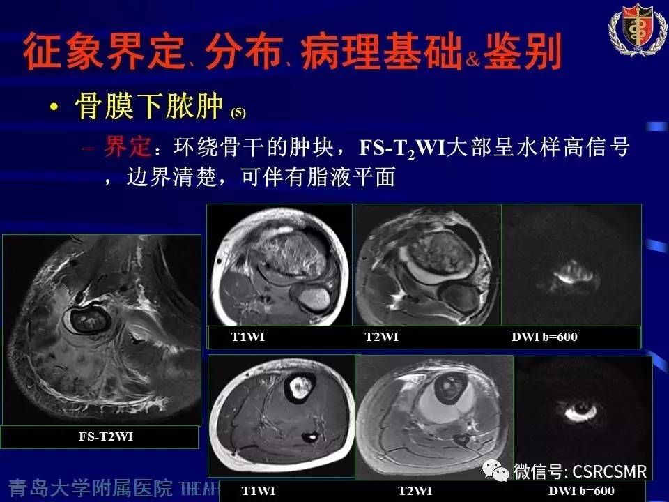 【PPT】长骨骨髓炎与骨肉瘤—MR征象对比观察