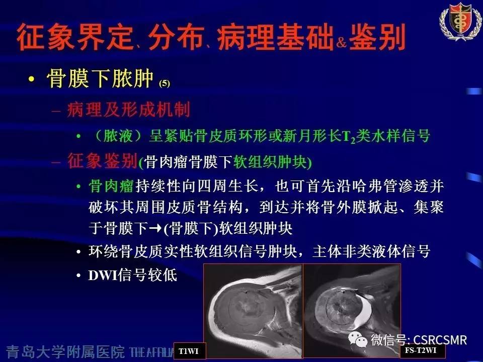 【PPT】长骨骨髓炎与骨肉瘤—MR征象对比观察