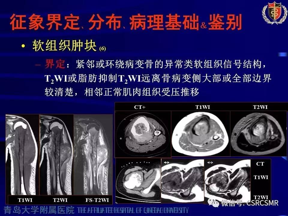 【PPT】长骨骨髓炎与骨肉瘤—MR征象对比观察
