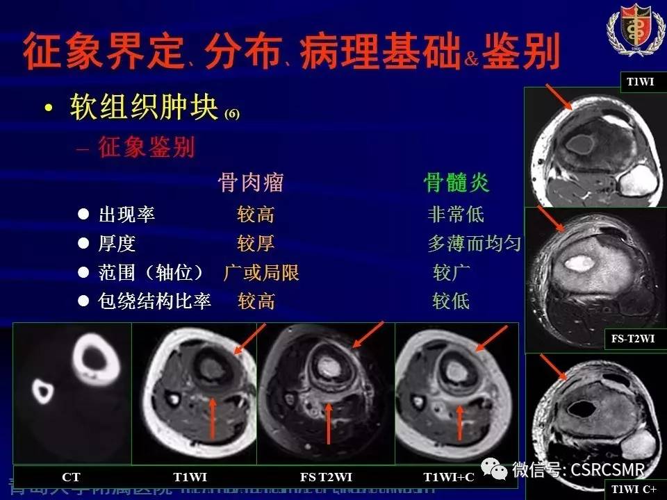 【PPT】长骨骨髓炎与骨肉瘤—MR征象对比观察