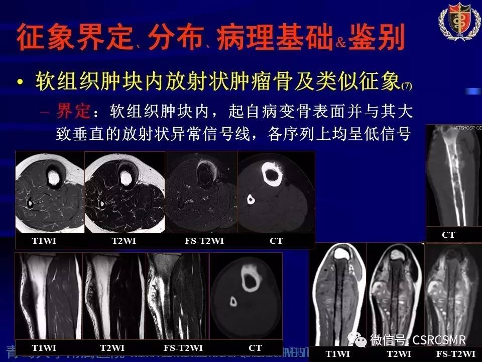 【PPT】长骨骨髓炎与骨肉瘤—MR征象对比观察