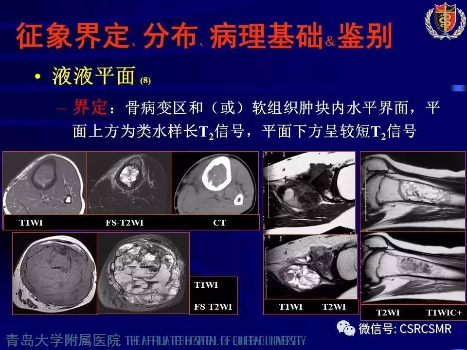 【PPT】长骨骨髓炎与骨肉瘤—MR征象对比观察