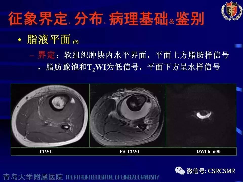 【PPT】长骨骨髓炎与骨肉瘤—MR征象对比观察