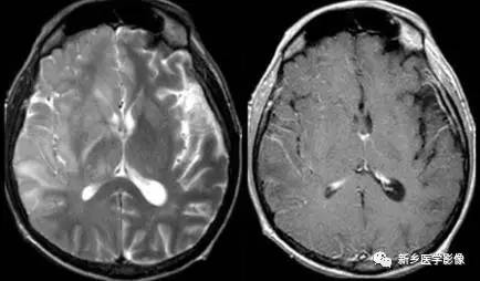 8种软脑膜强化的病变汇总 8种软脑膜强化的病变汇总